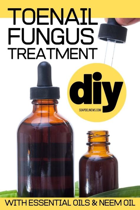 Diy Antifungal Cream, Toenail Fungus Essential Oils, Nail Remedies, Toenail Fungus Remedies, Nail Fungus Remedy, Natural Recipes, Vapor Rub, Foot Scrub, Toenail Fungus