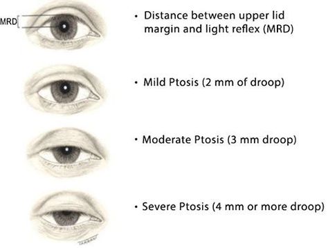 Ocular Prosthesis, Drooping Eyelids, Droopy Eyelids, Droopy Eyes, Cranial Nerves, Upper Eyelid, Eye Exercises, Eyes Problems, Eye Doctor