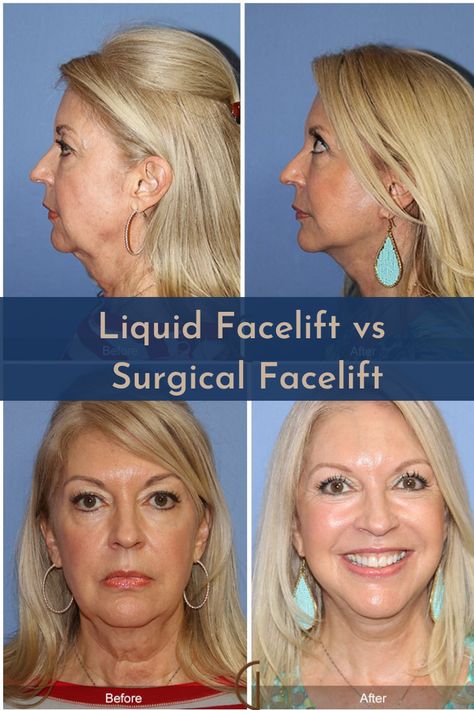 Profractional Laser, Facelift Before And After, Liquid Facelift, Non Surgical Facelift, Mom Beauty, Facial Fillers, Skin Care Routine 30s, Beauty Makeover, Facial Aesthetics