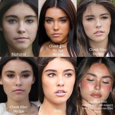 Brows And Lips Makeup, Jaw Implant Before And After, Madison Beer Plastic Surgeries, Filler Nose Job Before After, Jaw And Chin Filler, How To Lift Your Eyes, Eyebrow Botox Lift, Hip Filler Before And After, Madison Beer Lip Fillers