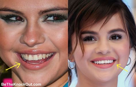 Selena Gomez Teeth, Selena Gomez Nose, Cheek Implants, Botox Lips, Prove Them Wrong, Celebrity Plastic Surgery, Bridesmaid Hair Down, Lip Injections, Nose Job