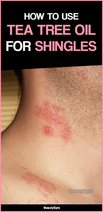 Shingles Remedies, Essential Oils For Shingles, Shingles Relief, Tea Tree Oil Uses, Coconut Oil Skin Care, Essential Oils For Pain, Oil Remedies, Essential Oils Herbs, Essential Oils Health