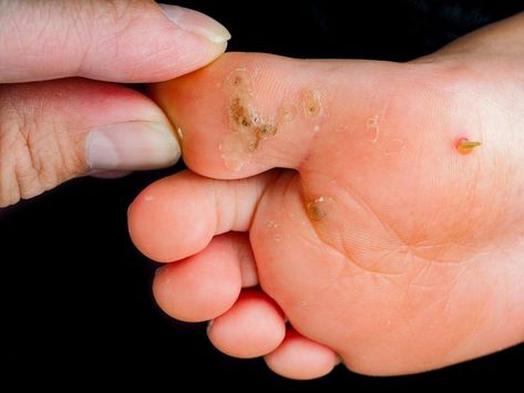 Plantar warts (also known as “verruca myrmecia” or “verruca plantaris”) are common viral skin infections that grow on the bottom of the feet. They are small, flat, hard circular growths, that look like a corn, callus or blister. Walking puts pressure on the wart, which makes it grow inward and builds a hard layer of skin over top. Walking or standing on the warts may also hurt. Click to Book Your Wart Removal Today! Plantar Warts, How To Stretch Shoes, Layers Of Skin, Small Flat, Foot Care, Healthy Living Lifestyle, Simple Way, Natural Skin, Toronto