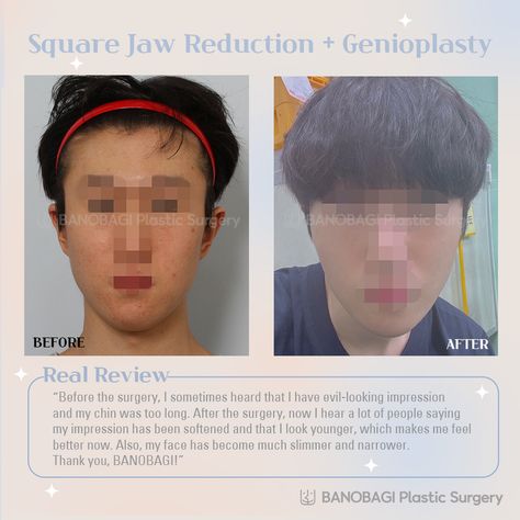 #banobagiplasticsurgery #plasticsurgeryinkorea #bestplasticsurgeoninkorea #plasticsurgerybeforeafter #koreancosmeticsurgery #facecontouringkorea #facecontour #fullfacecontouring #banobagi #koreanplasticsurgery #facecontouring #vlinesurgery #squarejawreduction #chinreduction #longface #genioplasty #zygoma #cheekbone #banobagi Look Younger, I Feel Good, Plastic Surgery, Feel Better, That Look, Feelings