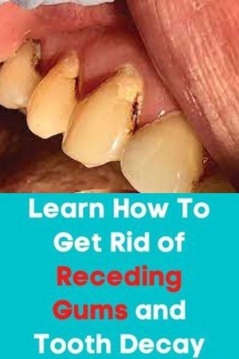 Reverse Receding Gums, Grow Back Receding Gums, Reverse Cavities, Tooth Repair, Heal Cavities, Perfect Teeth, Gum Care, Receding Gums, Gum Health