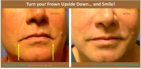 TURNED DOWNED LIP CORNERS/ LIP LIFT! Lip Lift, Botox Lips, Skin Care Specialist, Facial Fillers, Cosmetic Dermatology, Cosmetic Skin Care, Dermatology, Anti Aging, Click Here