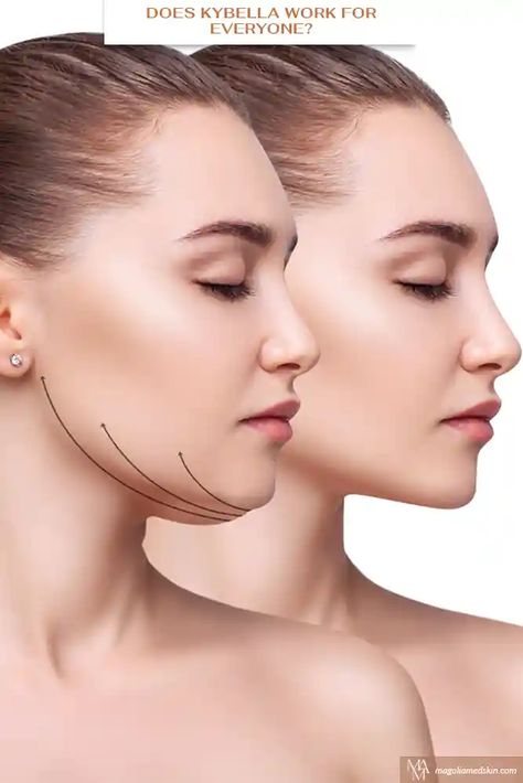 Does Kybella Work For Everyone? via @magnoliamedicalaesthetics Armonizacion Facial, Face Fillers, Skin Care Pictures, Skin And Hair Clinic, Facial Toning, Injectables Fillers, Natural Skin Care Routine, Flawless Beauty, Medical Aesthetic