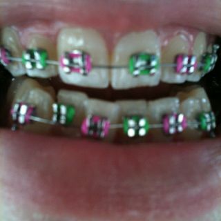 Second month. Hot pink & lime green! Pink And Green Braces, Neon Green Braces, Pink Braces, Green Braces, Braces Cost, Braces Tips, Straight Teeth, Smile Teeth, Teeth Braces