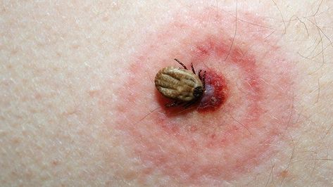 Here’s how you know you’ve been bitten by a tick, how to safely remove the tick, and when to see a doctor. Precautions must be taken if you suspect a tick bite, as it can lead to serious problems, such as Lyme disease and other infections. Tick Bite Symptoms, Vein Thrombosis, Tick Bite, Sjogrens Syndrome, Mosquito Bite, Menstrual Cramps, Dry Eyes, Ticks, How To Know