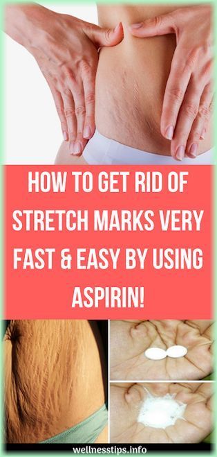 How to get rid of stretch marks very fast & easy by using aspirin! #stretchmarks #asp Stretch Mark Remedies, Severe Asthma, Diy Herbal Remedies, Health Tips For Women, Stretch Mark, Diy Beauty Hacks, Diy Health, Living Ideas, Health Info