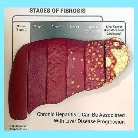 𝐌𝐞𝐝𝐢𝐜𝐚𝐥 𝐩𝐚𝐠𝐞 na Instagramie: „✨Stages of fibrosis ➡️ There are several different scales of liver fibrosis staging, where a doctor determines the degree of liver…” Gastrointestinal System, Nursing Student Tips, Flower Graphic Design, Medical School Motivation, Detox Water Recipes, Medical Tourism, Nursing Notes, Detox Your Body, Biology