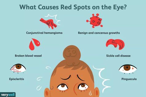 Possible Causes of a Red Spot on Your Eye Blood Vessel In Eye, Eye Disorders, Dry Eyes Causes, Bloodshot Eyes, Sjogrens Syndrome, Light Sensitivity, Eye Exam, Medical Terms, Red Blood Cells