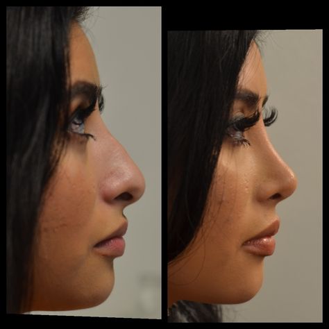 Droopy Tip Nose Rhinoplasty, Round Face Nose Job, Nose Job Front Profile, Nose Job Inspiration Front View, Nose Job Inspo Front View, Nose Job Inspiration Natural, Nose Job Front View, Bulbous Nose Rhinoplasty Before After, Perfect Nose Front View