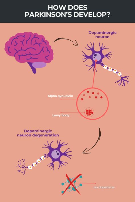 What is Parkinson’s disease? | Parkinson's News Today Parkinson Disease, Parkinsons Awareness, Lewy Body, Nerve Cell, Neurological Disorders, Sleep Problems, Pharmacology, Healing Process, Natural Treatments