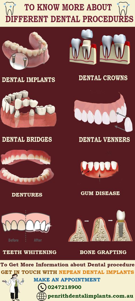 Dental Posters, Dental Videos, Dental Photography, Remedies For Tooth Ache, Dentistry Student, Sedation Dentistry, Dental Facts, Implant Dentistry, Restorative Dentistry