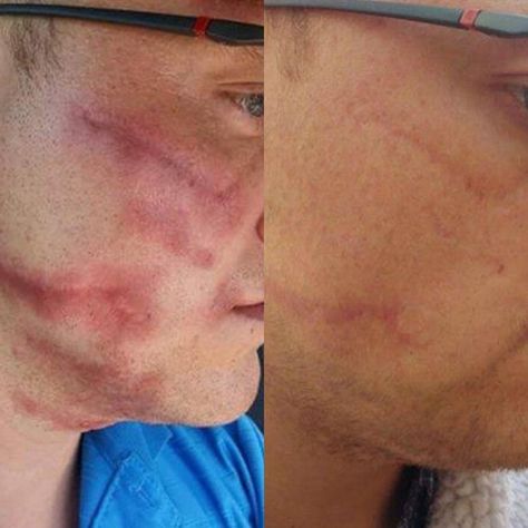 Before And After Acne, Dermapen Microneedling, Plasma Fibroblast, Skin Science, Brow Lash, Growth Factor, Scar Removal, Scarring, Conditioner