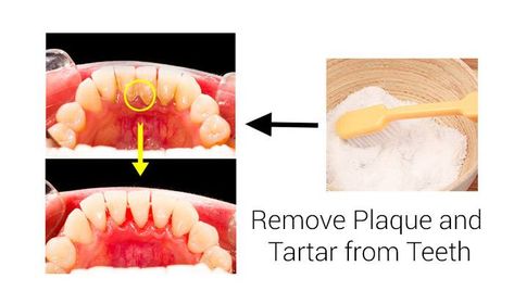 Teeth Tartar Removal, Cooking With Turmeric, Tartar Teeth, Plaque Teeth, Tartar Removal, Teeth Whitening Homemade, Top 10 Home Remedies, Dental Fillings, Whiter Teeth