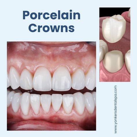 Dental Caps, Porcelain Crowns, Tooth Crown, Discolored Teeth, Front Teeth, Dental Crowns, Dental Cosmetics, Natural Teeth, Park Avenue