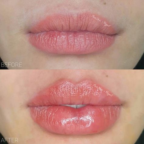 Lip Filler Technique, Lip Fillers Juvederm, Saggy Cheeks, Juvederm Lips, Lips Inspiration, Facial Fillers, Lip Augmentation, Serious Skin Care, Lip Filler