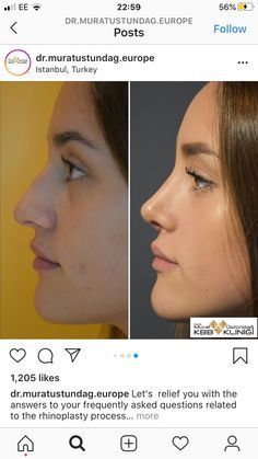 Rhinoplasty Before After Dorsal Hump, Dream Nose Job, Nose Job Inspo Front View, Perfect Nose Rhinoplasty, Best Nose Jobs, Nose Job Inspiration, Nose Job Inspo, Natural Nose Job, Nose Job Recovery