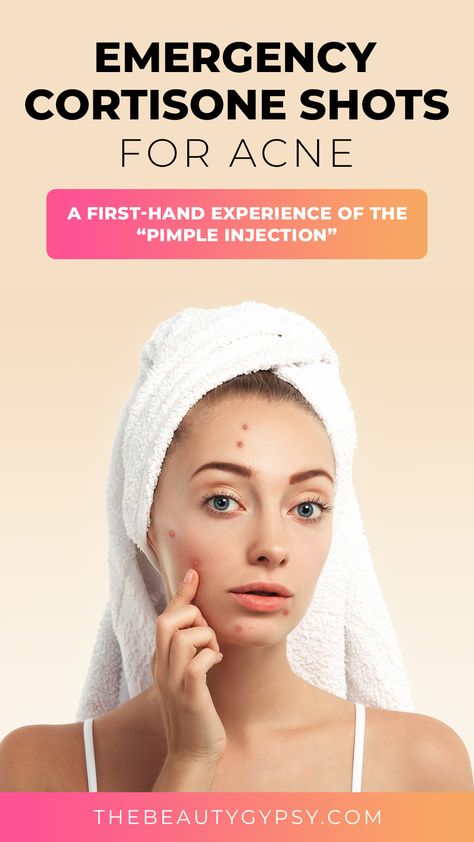 cortisone shot for acne Get Rid Of Cystic Acne, Beauty Bar Ideas, Beauty Care Logo, Beauty And The Beast Tattoo, Beauty And The Beast Costume, Beauty Crush, Growing Healthy Hair, Tips For Oily Skin, Pimples Remedies