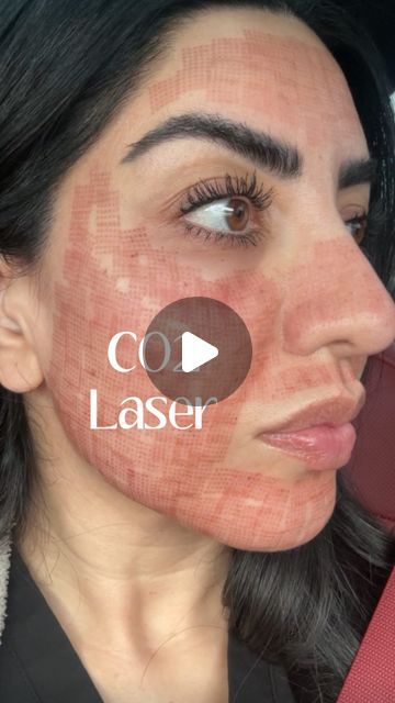 Skinfx Medical Spa on Instagram: "CO2 skin resurfacing is a cosmetic procedure that uses a carbon dioxide (CO2) laser to remove layers of skin in a precise manner. 

This process helps to improve skin tone, texture, and appearance by stimulating collagen production and promoting skin regeneration. It can be used to treat various skin issues such as wrinkles, fine lines, scars, sun damage, and uneven pigmentation. 

However, it typically requires some downtime for the skin to heal properly.

I got mine done at @dmhaesthetics by @dr.o.aesthetics 🖤

Would you try this procedure?👇🏻" Laser Scar Removal Before And After, Skin Regeneration, Skin Resurfacing, Improve Skin Tone, Collagen Production, Cosmetic Procedures, Layers Of Skin, Medical Spa, Carbon Dioxide