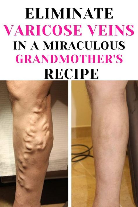 Get rid of varicose veins with a natural recipe that’s easy to make at home. Follow these eight simple steps and enjoy healthier, more beautiful legs. Ingredients: Instructions : Note : The preparation time for this recipe is about 15 minutes. However, you will need to leave the paste on for 30 minutes, so be […] Vericous Veins, Varicose Veins Essential Oils, Varicose Vein Remedy, Leg Veins, Vein Removal, Natural Beauty Tips, Natural Treatments, Home Remedies, Cider