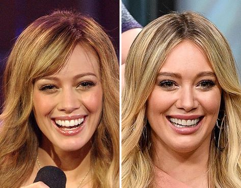 Celebrity Teeth Before & After | iHeart Bad Veneers, Celebrities With Veneers, Perfect Teeth Smile, Celebrity Teeth, Teeth Aesthetic, Dentist Day, Celebrity Smiles, Disney Actresses, Veneers Teeth