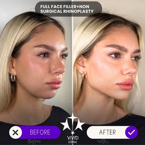 💉✨ Sculpt and define your face with Jawline Filler at Vivid Clinic! Check out this stunning Client Transformation—perfectly contoured, sharper jawline for a more defined and balanced appearance. 💎 ✅ Enhances facial definition ✅ Non-surgical with immediate results ✅ Long-lasting, natural-looking transformation 💬 Want to achieve a similar look? Book your free consultation today and take the first step toward a more sculpted you! 📍Located in Istanbul, Turkey 🌐 vividclinic.net 📞 🇺🇸 +90 545 742... Jawline Contouring Filler, Chin And Jawline Fillers, Receding Jawline, Facial Balancing Before And After, Jaw Filler Before And After, Face Balancing Fillers, Jawline Fillers Before And After, Facial Balancing Filler, Facial Definition