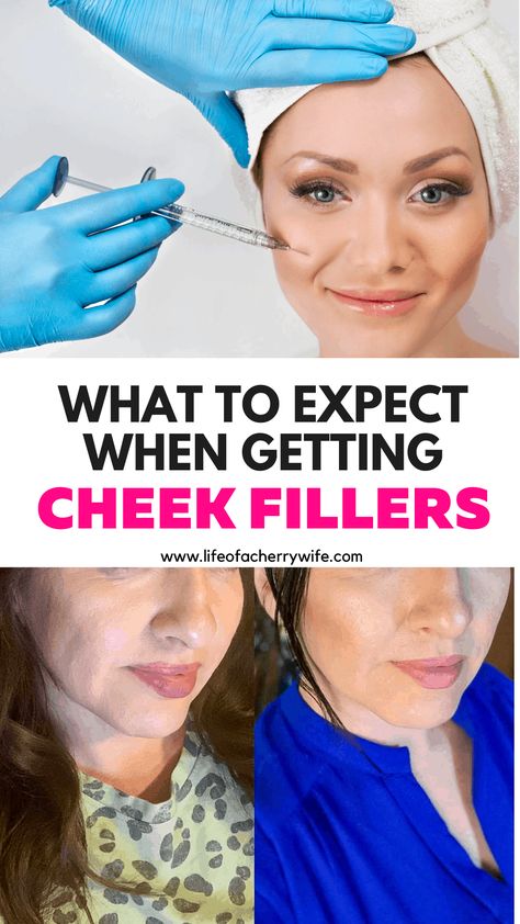 Filler In Cheeks Before And After, Check Filler Before And After, Face Fillers Before And After Cheeks, Before And After Cheek Filler, Facial Fillers Before And After, Face Fillers Before And After, Cheekbone Filler Before And After, Cheek Fillers Before And After Face, Voluma Cheeks