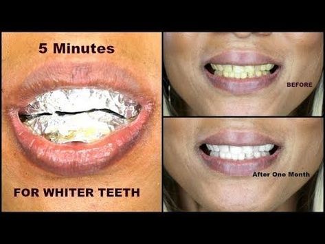 Khichi Beauty, Diy Teeth Whitening, White Teeth Diy, Make Teeth Whiter, Diy Teeth, Natural Teeth Whitening Diy, Teeth Whiting At Home, Activated Charcoal Teeth Whitening, Teeth Whitening Diy