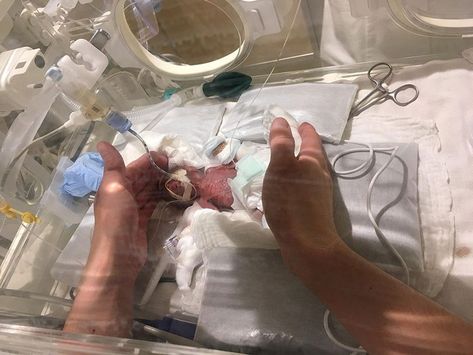 World’s Smallest Boy (Born 268g/9.45oz) Gets Discharged From Hospital «Born in Tokyo, Japan 16 weeks early last August, the baby boy weighed just 268 grams (9.45 ounces) at birth.Now weighing 3.2 kg (7.05 pounds), the amazing little baby was sent home from the hospital at the end of February. Bayi Prematur, Bawang Bombay, Neonatal Intensive Care Unit, Baby Ready, Preemie Babies, Miracle Baby, Premature Baby, Small Boy, Small Baby