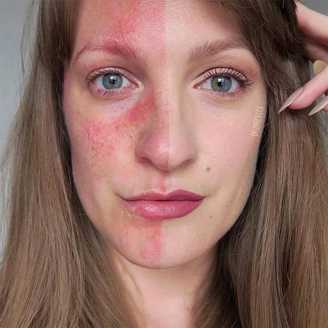 Rosacea and make up - how it can help, why it's important to some people, and tips for using make up to cover rosacea. Rosacea make up tips.  #talontedlex #rosaceaadvice #rosaceatips Skin Positivity, Haut Routine, Real Skin, Skin Dryness, Skin Routine, Pure Beauty, Skin Conditions, Skin Treatments, Beautiful Skin