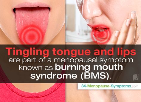 Tingling Tongue and Lips: What's Going On? | Menopause Now Lie Bumps On Tongue, Bumps On Tongue, Tongue Problems, Burning Mouth, Burning Tongue, Tongue Health, Migraine Headaches, Thyroid Health, Alternative Health