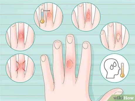 4 Ways to Heal Blisters - wikiHow Heal Blisters, How To Heal Blisters, Blood Blister, Fever Blister, Ways To Heal, Green Tea Bags, Prevent Blisters, Talcum Powder, School Of Medicine