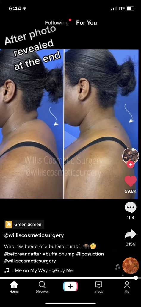 Buffalo Hump Before And After, Quadruple Bypass Heart Surgery, Lower Blephoraplasty Surgery, Lobectomy Surgery, Brazilian Buttlift, Rhinoplasty Before After Dorsal Hump, Cosmetic Surgery, My Way, Surgery