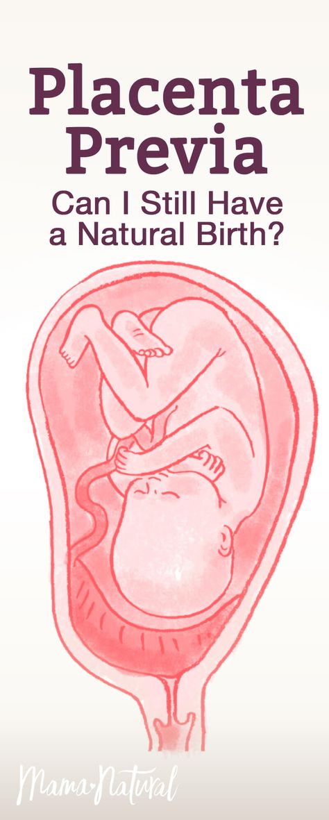 It's disappointing to find out you have placenta previa. What does this mean for you and baby? What does it mean for your natural birth plan? Find out here. https://www.mamanatural.com/placenta-previa/ Previa Placenta Pregnancy, Low Lying Placenta, Placenta Art, Anterior Placenta, Natural Birthing Plan, Spinning Babies, Doula Care, Pregnancy Pain, Where To Buy Bedding