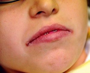 Signs of angular cheilitis will nearly appear at the edges of the mouth. Find out more about cracks corners of mouth diagnosis and its treatments. #angularcheilitisremedyessentialoils Cracked Corners Of Mouth, Angular Cheilitis, Crusty Skin, Natural Aloe Vera, Cracked Lips, Cracked Skin, Skin Disorders, My Mouth, How Do I Get