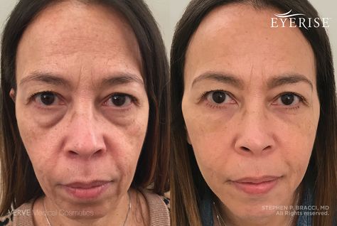 Eye Bag Surgery, Eye Bag Removal, Cosmetic Fillers, Facelift Procedure, Facial Aging, Under Eye Fillers, Sunken Eyes, Remove Eye Bags, Non Surgical Facelift