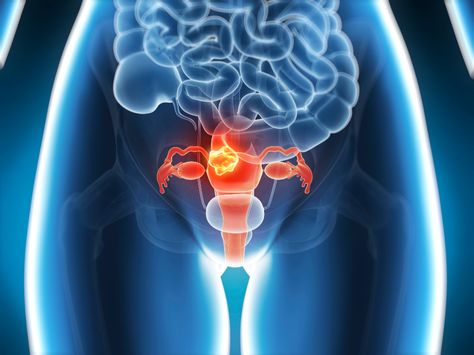 Uterus Detox: How To Clean Your Uterus Naturally | BlackDoctor.org Weak Bladder, Deadly Females, Remedies For Nausea, Signs And Symptoms, Human Body, Human