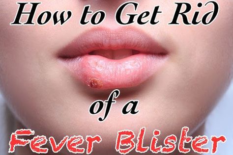 Best Ways To Get Rid Of Fever Blisters on Lip - How to Get Rid of Things Fever Blister Remedy, Blister Remedies, Blister On Lip, Fever Blister, Cold Sores, Holistic Remedies, Hydrogen Peroxide, Living A Healthy Life, Whole Milk