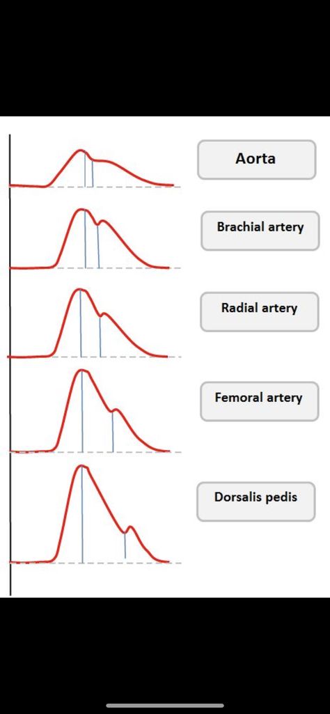 Arterial Line, Line Chart, Art