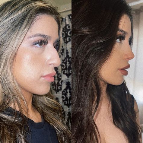 Nose Job Transformation, Thick Skin Rhinoplasty, Dorsal Hump Rhinoplasty, Nose Job Before And After Rhinoplasty, Nose Job Inspiration Natural, Nose Job Front View, Bulbous Nose Rhinoplasty Before After, Rhinoplasty Before After, Wide Nose Rhinoplasty