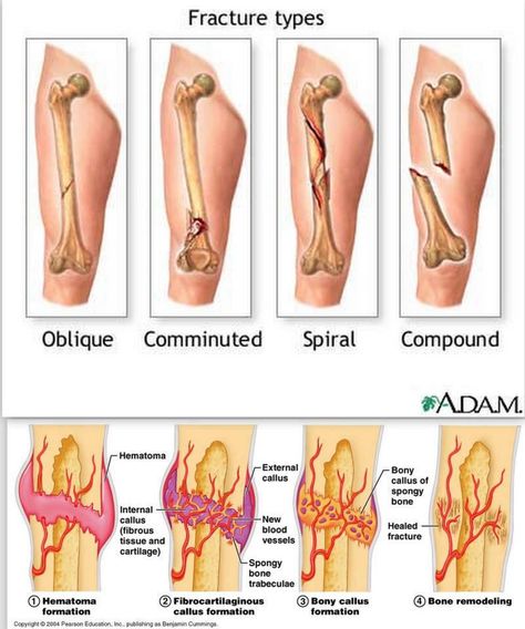 Fracture types and Stages of healing: All fractures can be broadly described as: Closed (simple) fractures: are those in which the sk... Emt Study, Fracture Healing, Bone Fracture, Nursing Mnemonics, Emt Paramedic, Emergency Medical Technician, Medical Student Study, Musculoskeletal System, Medicine Student