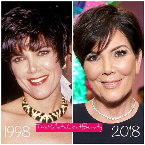 Best of Plastic Surgery on Instagram: “🤔 What has Kris Jenner done to her face?! . I tried to find 2 fair comparison photos showing Kris without fancy filters or the heavy…” Kris Jenner, Plastic Surgery, I Tried, Surgery, Statement Necklace, On Instagram, Instagram