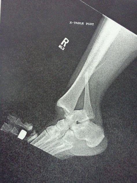 Dislocated ankle with broken Fibula :-( Learning Medicine, Dislocated Ankle, Broken Fibula, Medical Radiography, Hospital Admit, Radiology Imaging, Hospital Admit Hand Pics, Broken Ribs, Broken Ankle