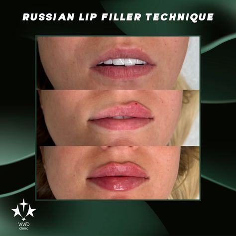 💋✨ Achieve perfectly defined, fuller lips with the Russian Lip Filler Technique at Vivid Clinic! This advanced technique creates beautifully shaped lips with more height and less volume for a natural, elegant pout. 💉 ✅ Focuses on lip height and shape ✅ Creates a subtle, natural-looking pout ✅ Long-lasting, stunning results 💬 Ready to enhance your lips? Book your free consultation today and experience the art of the Russian Lip Filler Technique at Vivid Clinic! 📍Located in Istanbul, Turkey ... Russian Lip Filler Technique, Lip Filler Technique, Russian Lip Filler, Lip Book, Fuller Lips, Lip Filler, Lip Injections, Lip Fillers, Istanbul Turkey