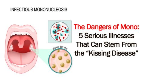 Kissing Disease, Extreme Fatigue, Autoimmune Disorders, Inflammatory Bowel, Feeling Fatigued, Inflammation Causes, Serious Illness, Lack Of Energy, Lymph Nodes