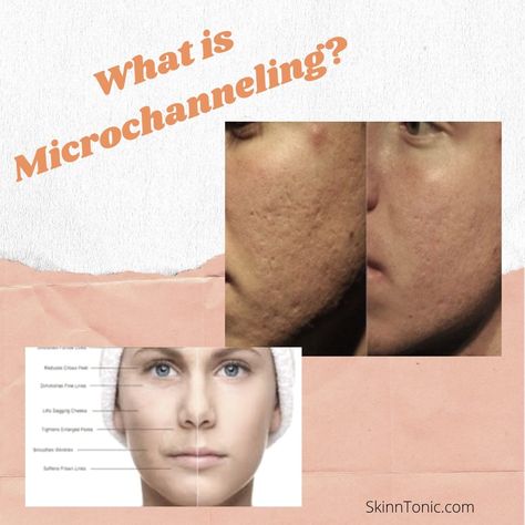 Microchanneling Before And After, Procell Microchanneling Before And After, At Home Microneedling, Procell Microchanneling, Radiofrequency Microneedling, After Microneedling, Epidermal Growth Factor, Stretch Mark Removal, Stem Cell Therapy