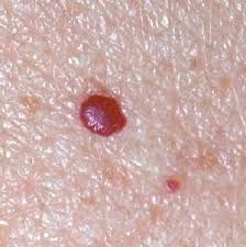 ANGIOMAS CAPILARES Cherry Angioma, Iodine Deficiency, Health Heal, Thyroid Health, Alternative Health, Health Matters, Health Info, Natural Medicine, Warning Signs